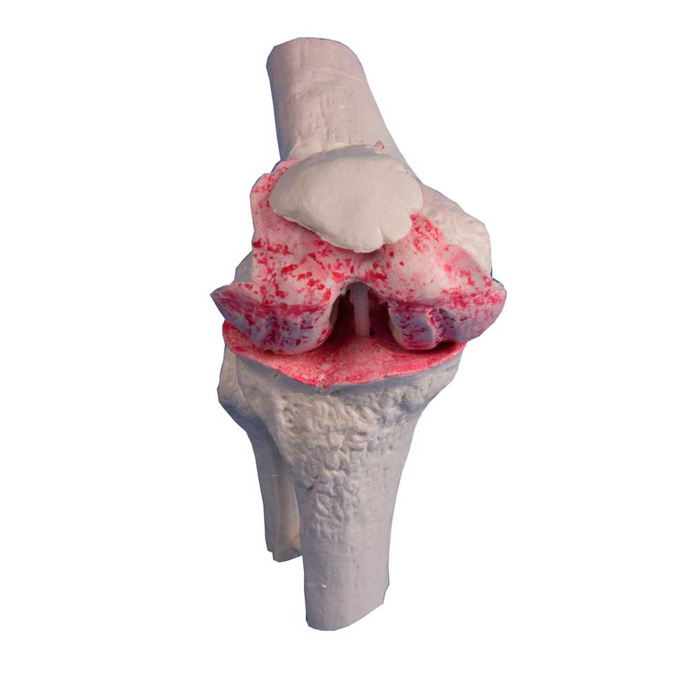 Erler Zimmer Knee Implant Model, 3 pcs, Healthy, Diseased, Implant
