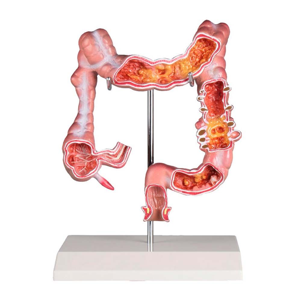 Erler Zimmer Desktop Model - Colon with Diseases