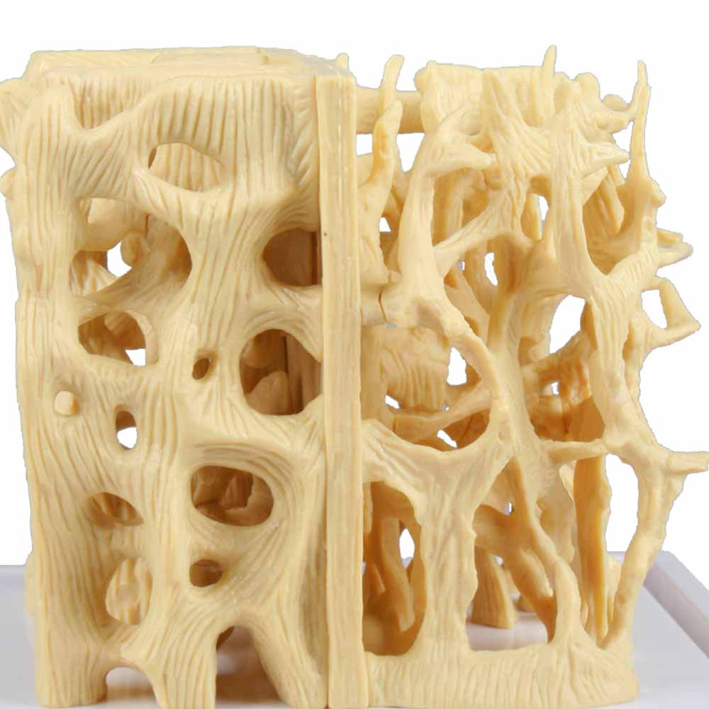 Erler Zimmer Comparision Model - Healthy/Osteoporotic Bone Structure