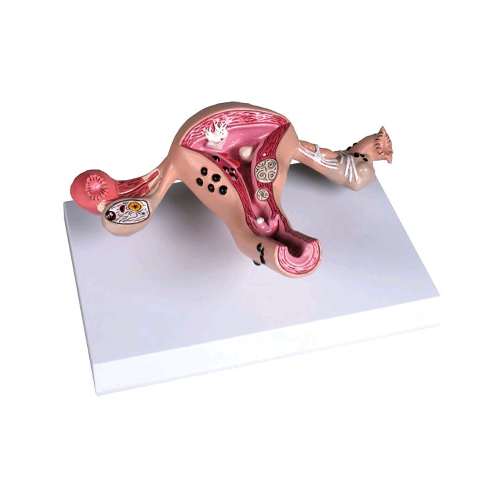 Erler Zimmer uterus model with diseases, life-size, teaching map