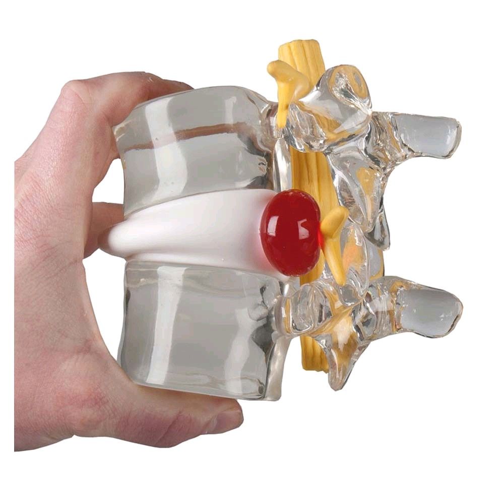 Increased herniated disc simulator of Erler Zimmer, 2-fold