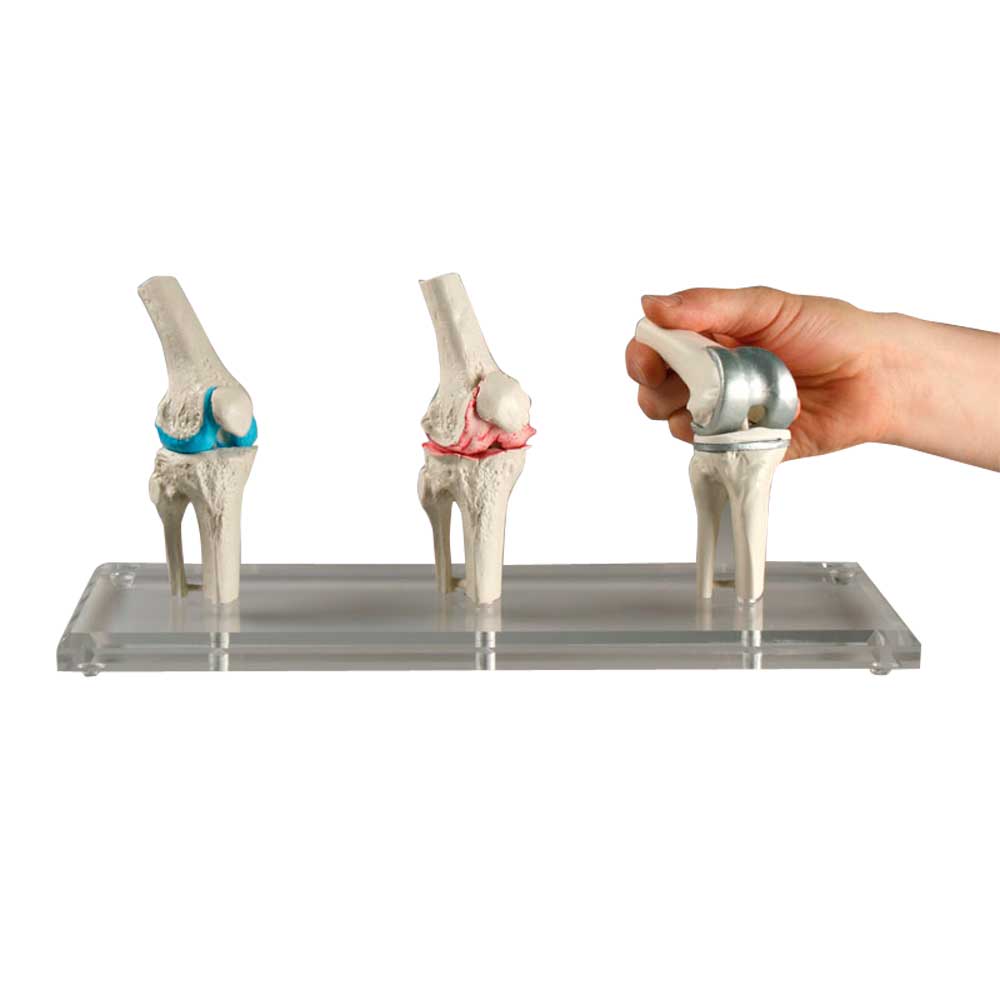 Erler Zimmer Knee Implant Model, 3 pcs, Healthy, Diseased, Implant