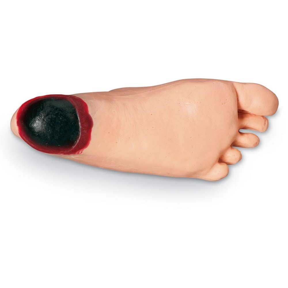 Erler Zimmer Edema Foot with Deep Tissue Injury for Geri/Keri