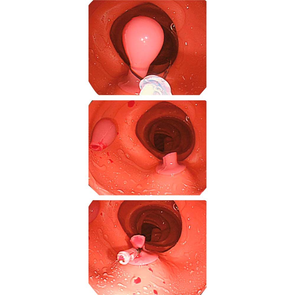 Erler Zimmer Simulated Polyps - Upgrade for Training Model LM107