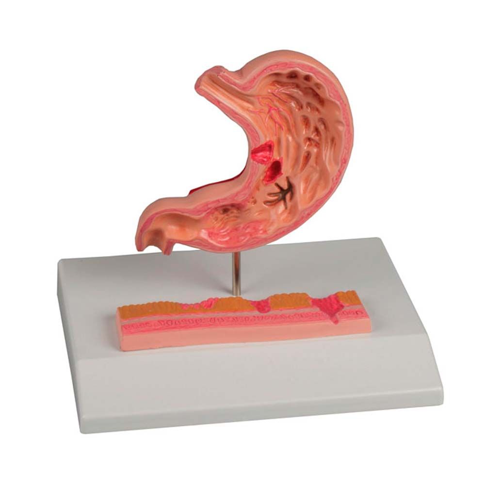 Erler Zimmer Desktop Model - Stomach with Ulcers