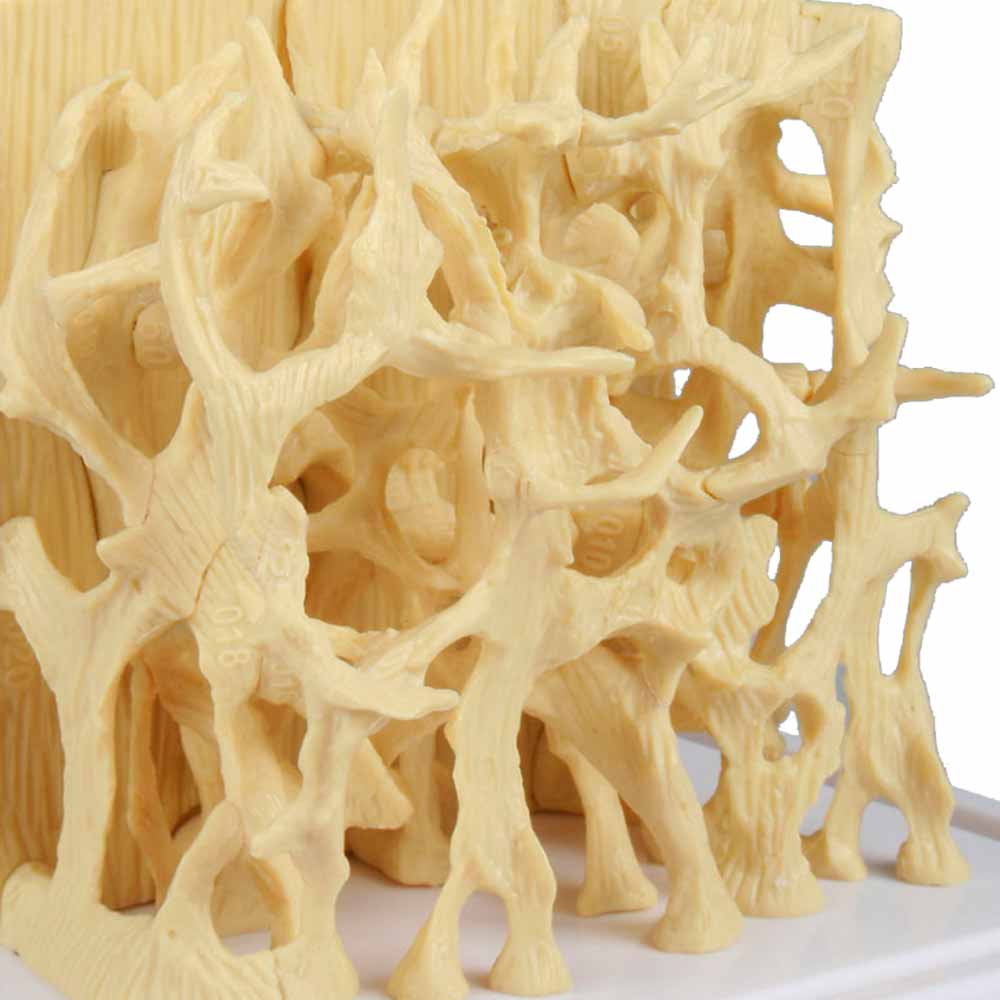 Erler Zimmer Comparision Model - Healthy/Osteoporotic Bone Structure