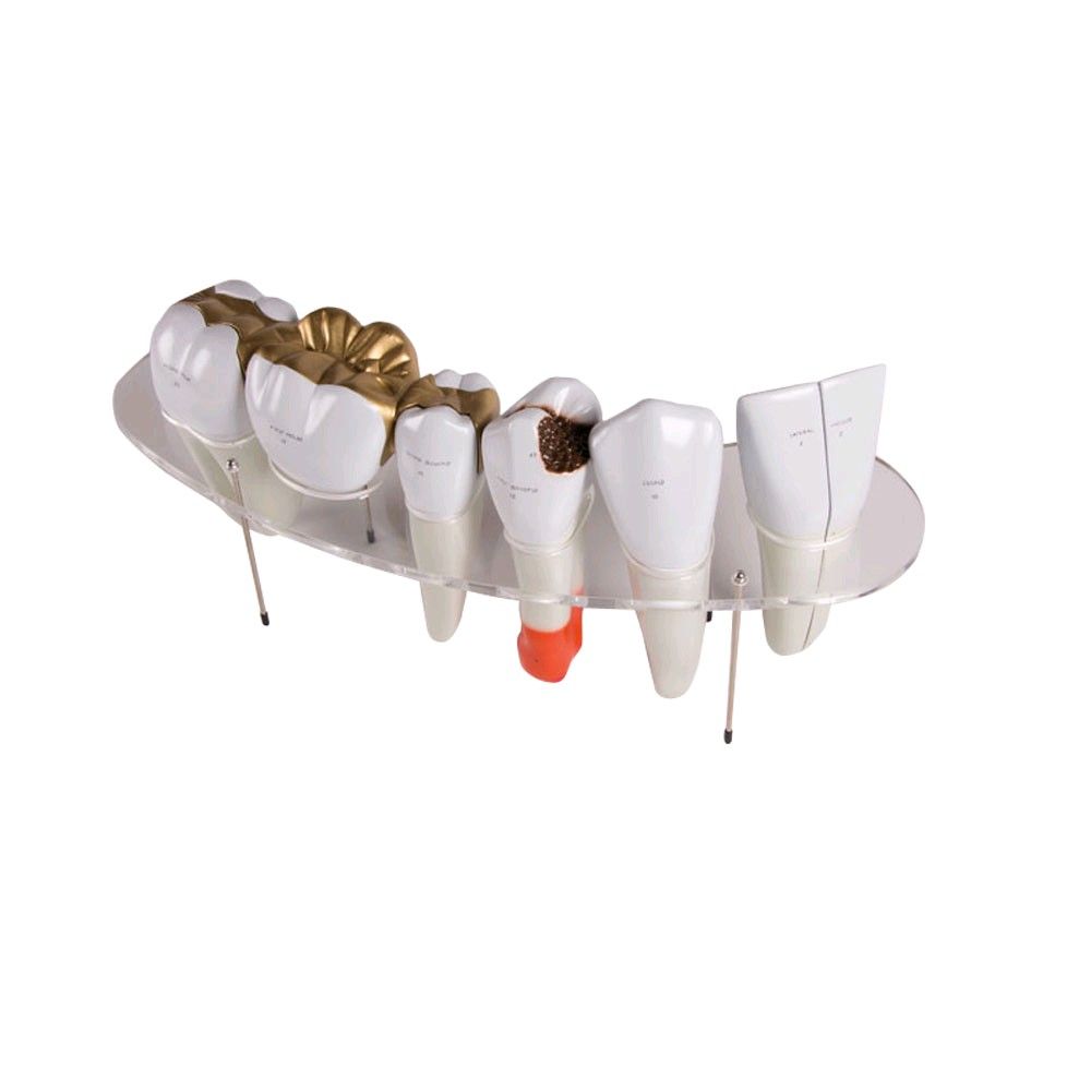 Dental model by Erler Zimmer, lower jaw with teeth 3 -7, disease