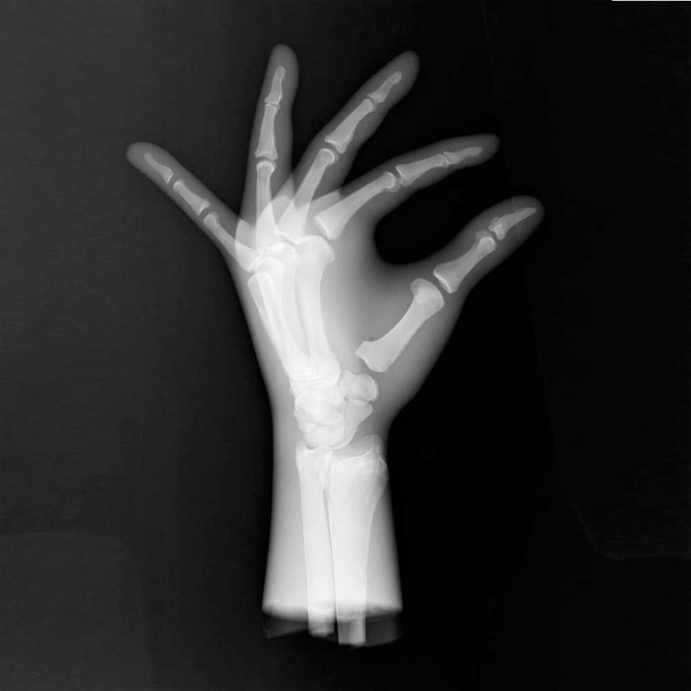 Erler Zimmer Sectional X-Ray Phantom, Artif. Bones, Hand Le, Transp