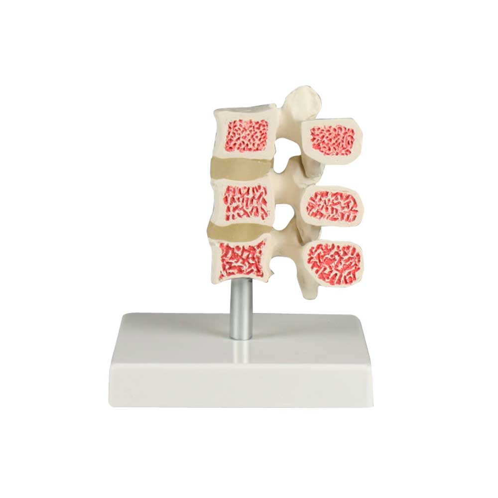 Erler Zimmer Osteoporotic Spine Model, 3 Vertebrae