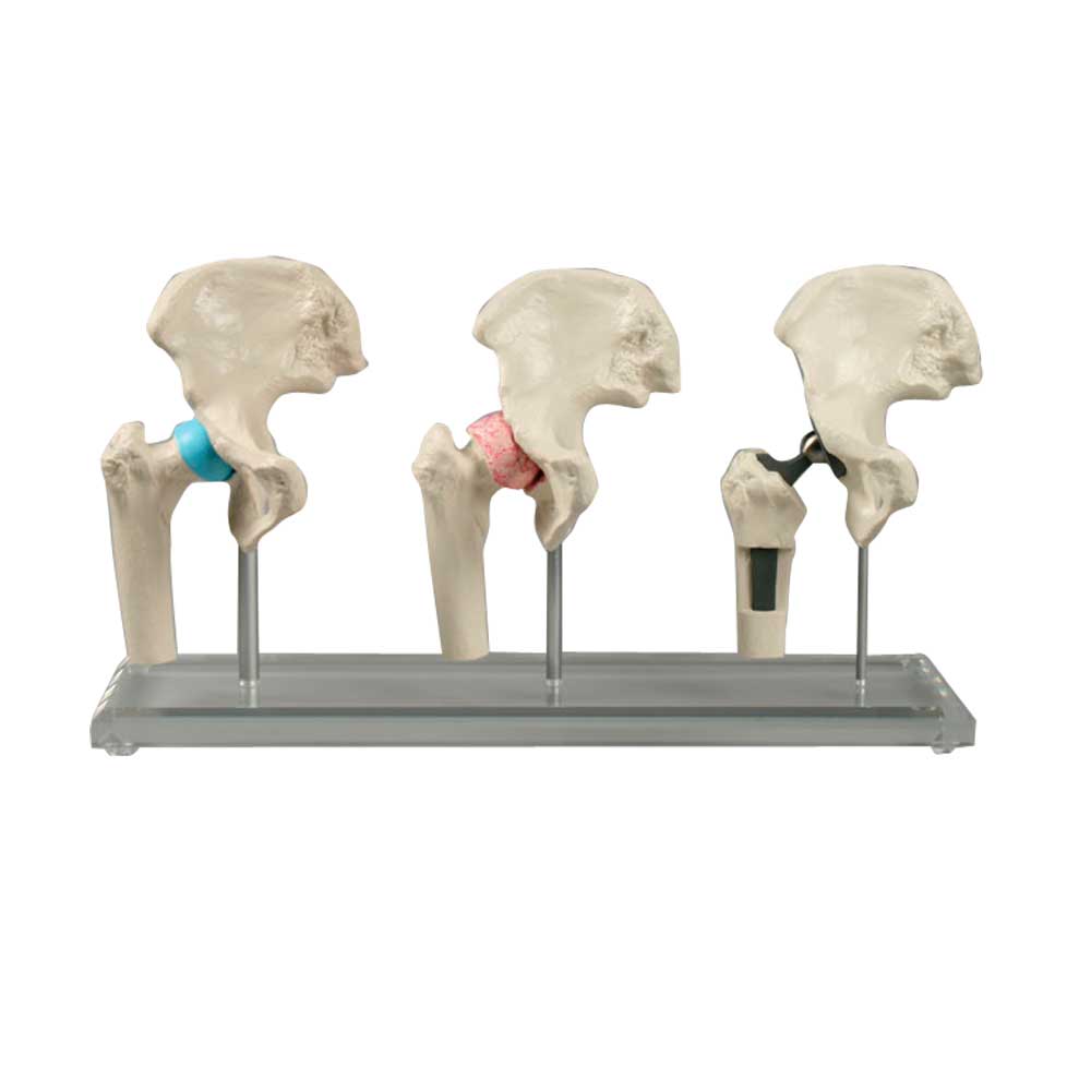 Erler Zimmer scaled down Hip Implant Model, 3 pcs