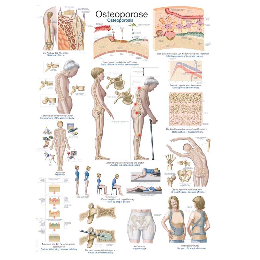 Erler Zimmer anatomical chart "osteoporosis", 70x100cm, plastic film