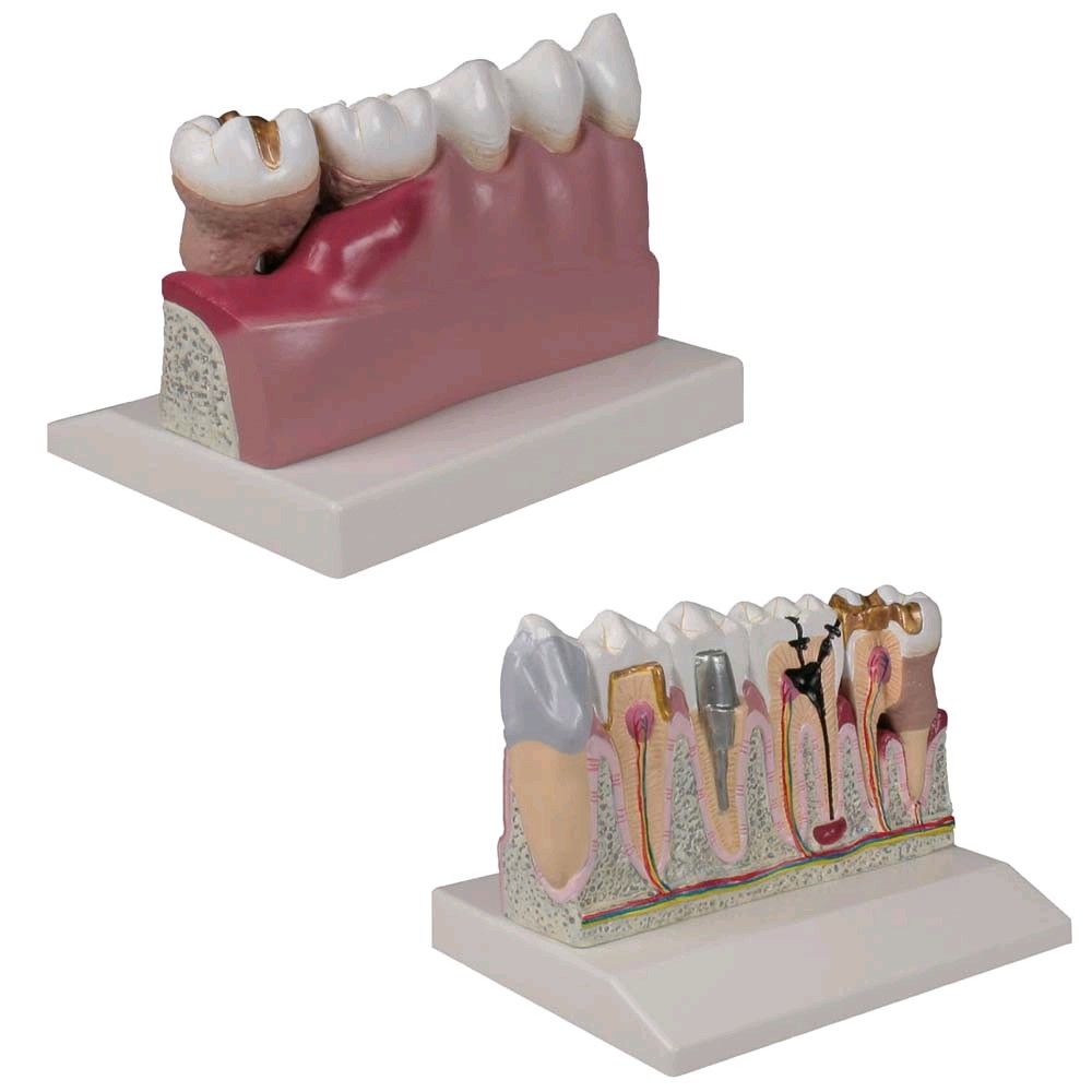 Dental model by Erler Zimmer, lower jaw with teeth 3 -7, disease
