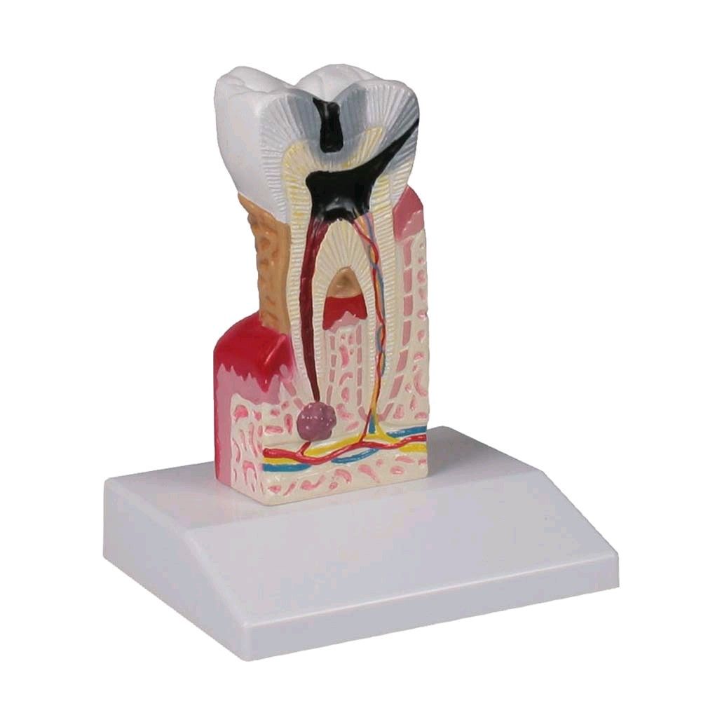 Dental caries model Erler Zimmer, lower molar, 10 times full-size
