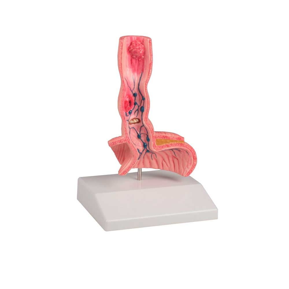 Erler Zimmer Desktop Model - Oesophagus Diseases