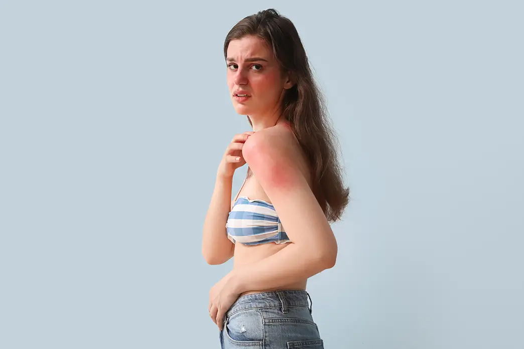 Sun allergy often occurs in the spring on skin areas that have not been exposed to UV radiation for a long time Young woman with skin reddened by sun allergy on her upper arm and face