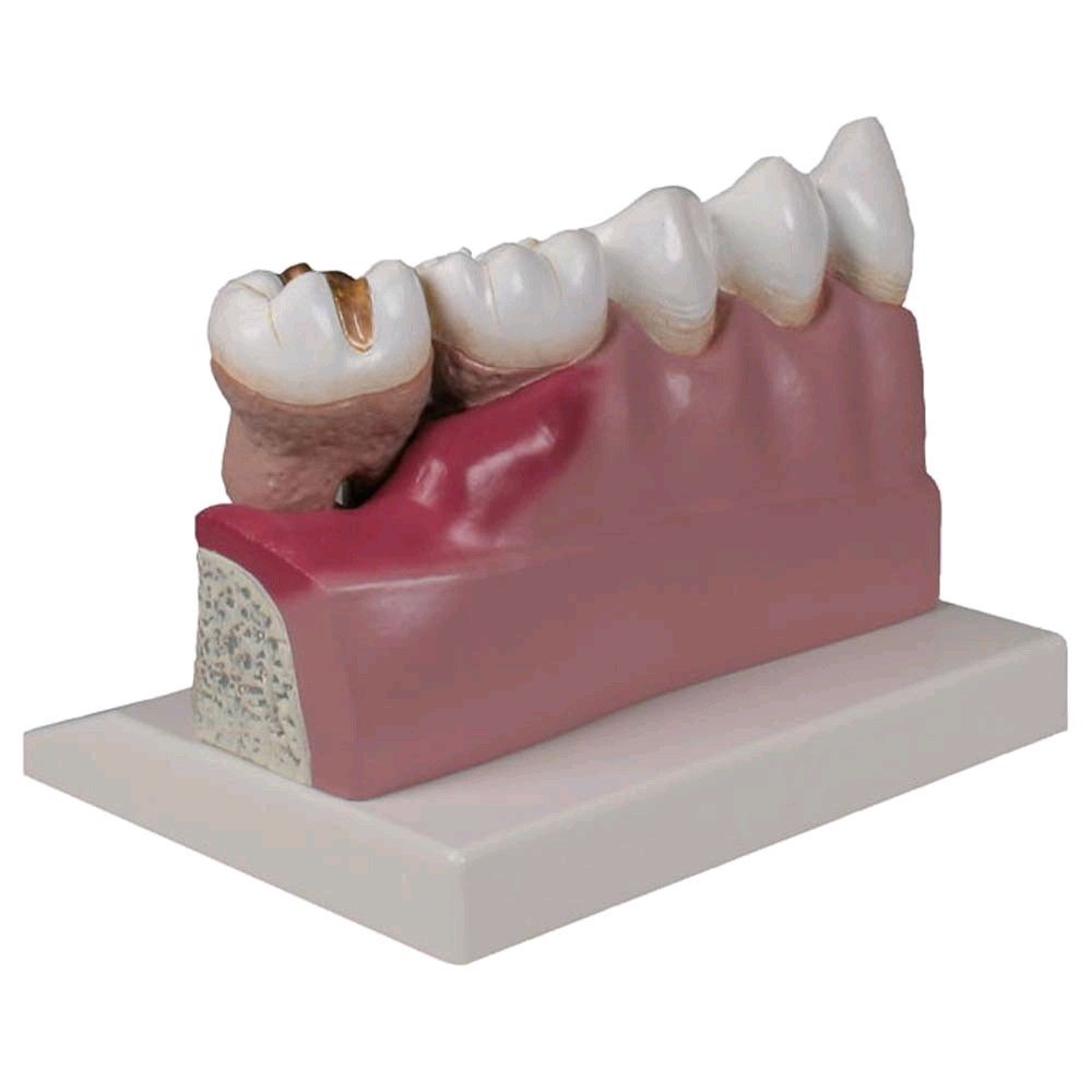 Dental model by Erler Zimmer, lower jaw with teeth 3 -7, disease