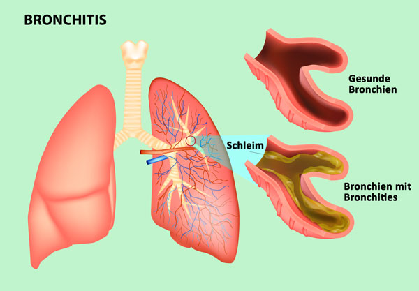 Irritated mucous membranes caused by bronchitis can be treated with an inhalation device Therapeutic application of an inhalation device for bronchitis