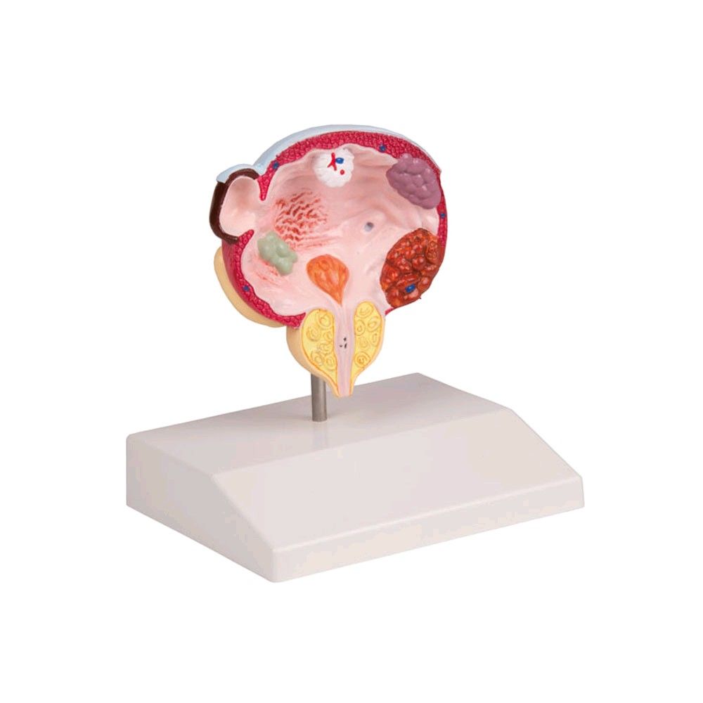 Erler Zimmer bladder and prostate model, 5 pathologies lifesize