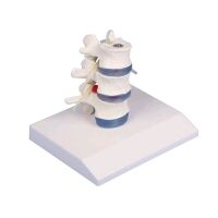 Erler Zimmer lumbar model with disc herniation, can be...