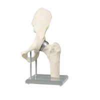 Erler Zimmer Hip Joint with Resurfacing Implant -...