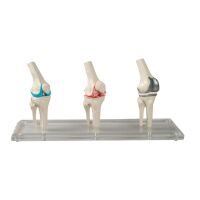 Erler Zimmer Knee Implant Model, 3 pcs, Healthy,...